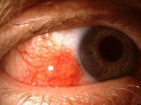 Best Eye Scleritis treatment in Sector 51, Gurugram