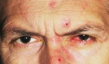 best eye herpes zoster treatment in Sector 51, Gurugram